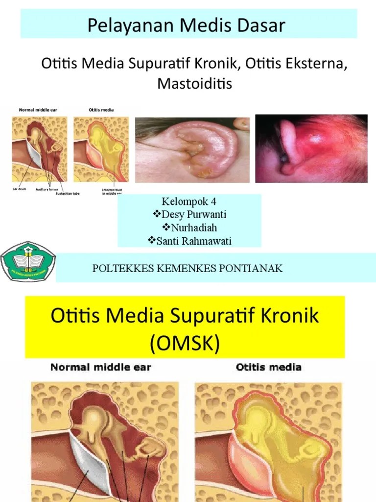 Otitis Media Supuratif Kronik Omsk
