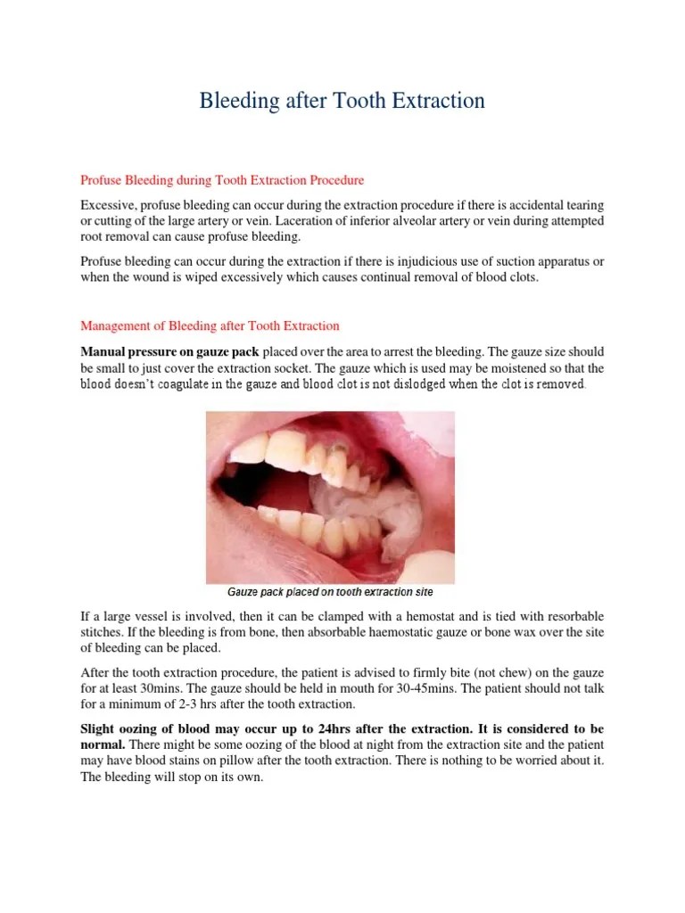 Bleeding After Tooth Extraction PDF Bleeding Animal Anatomy
