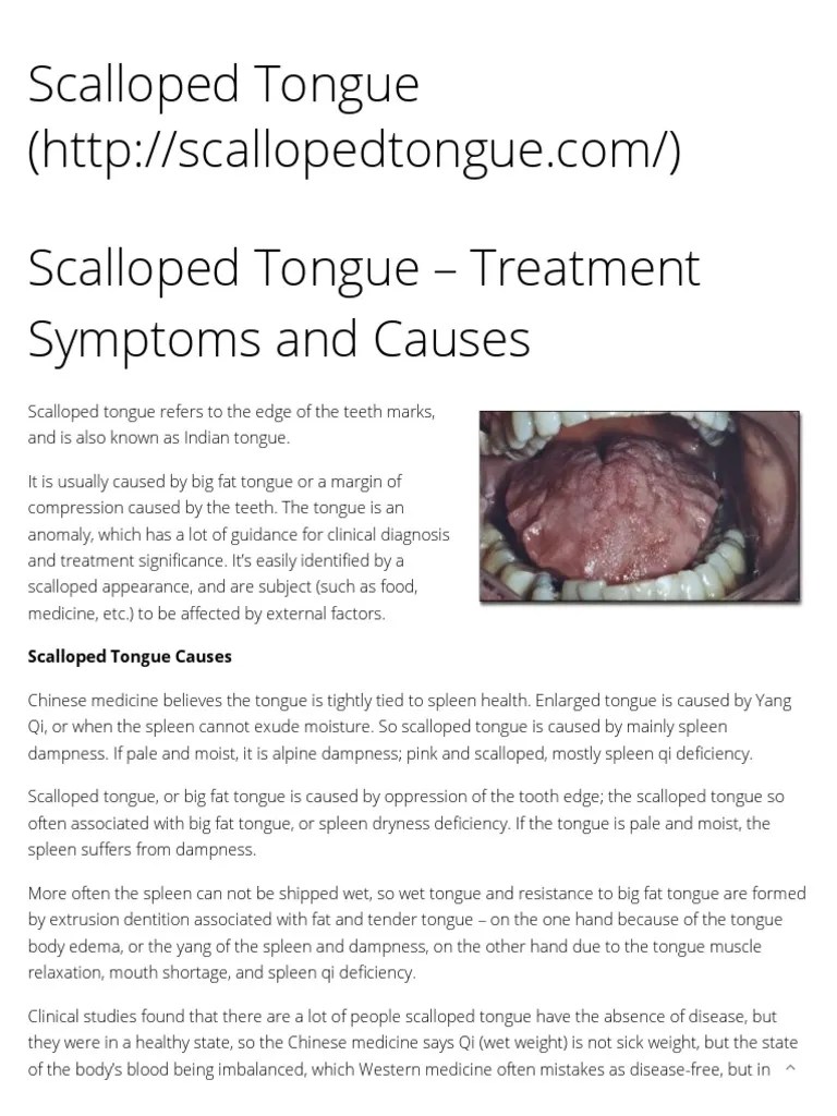 Scalloped Tongue Treatment Symptoms and Causes Scalloped Tongue Traditional Chinese