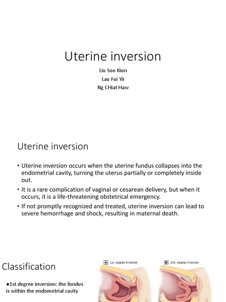 Uterine Inversion Uterus Obstetrics