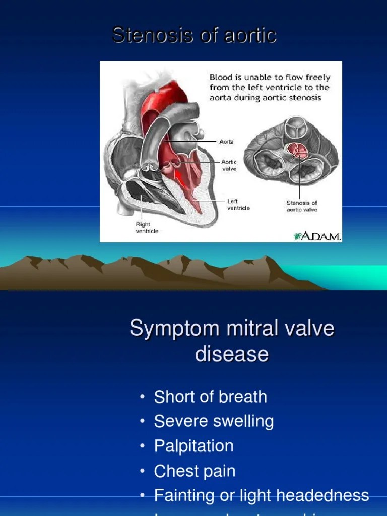 Stenosis of Aortic Heart Valve Heart