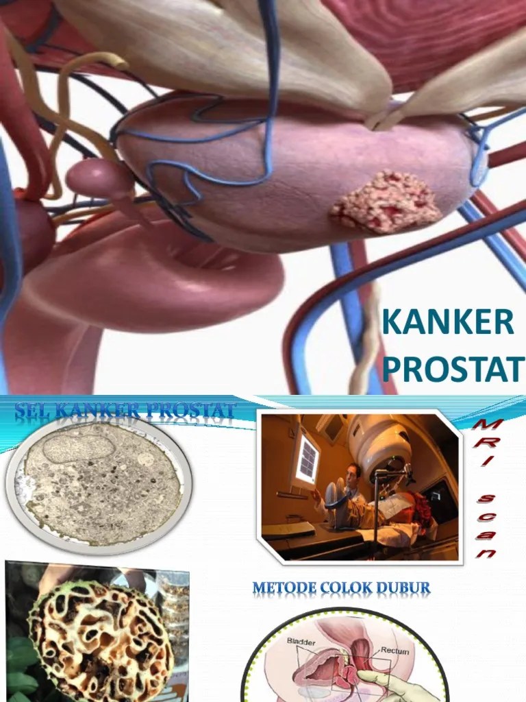 KANKER PROSTAT