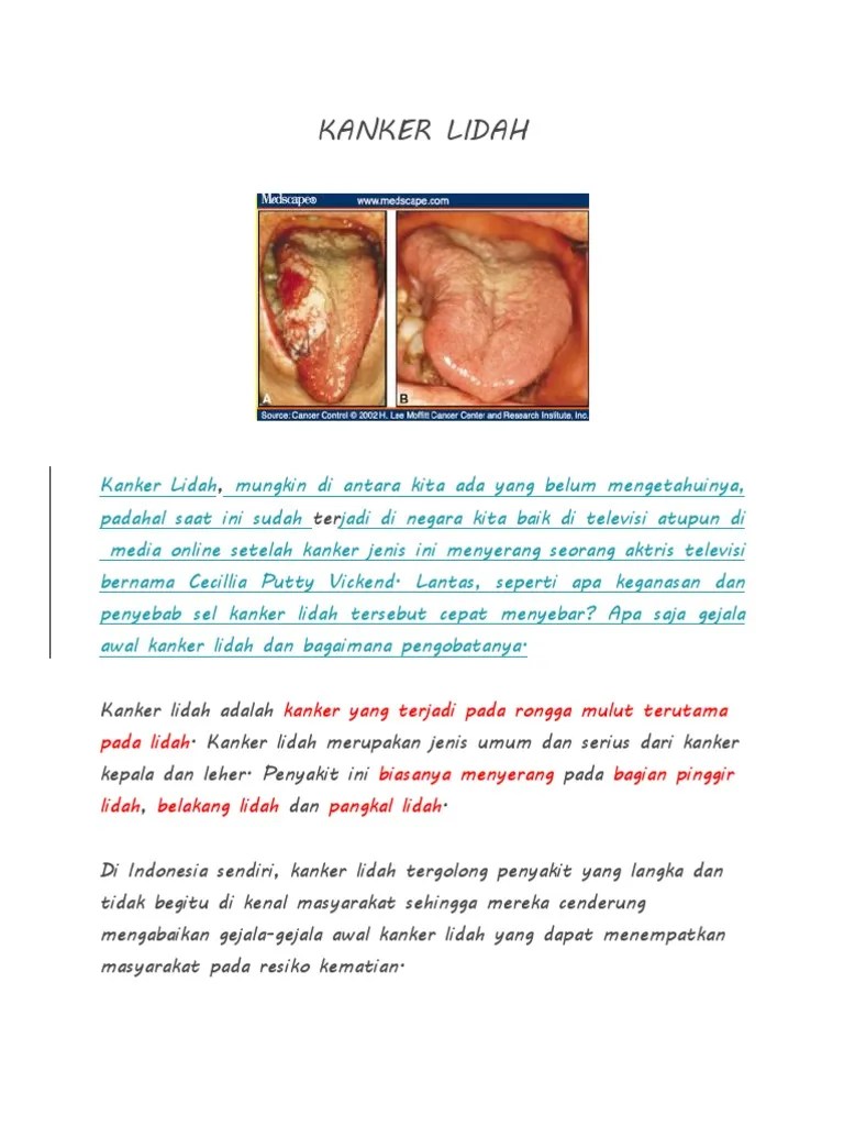 KANKER LIDAH.docx