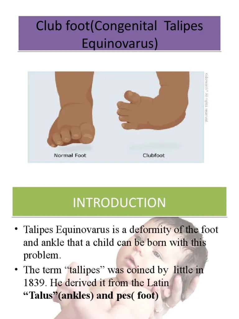Download the perfect feet pictures. Club Foot Foot Congenital Disorder