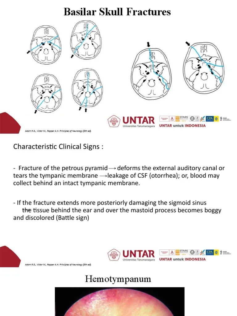 Clinical Presentation, Diagnosis, and Treatment of Basilar Skull