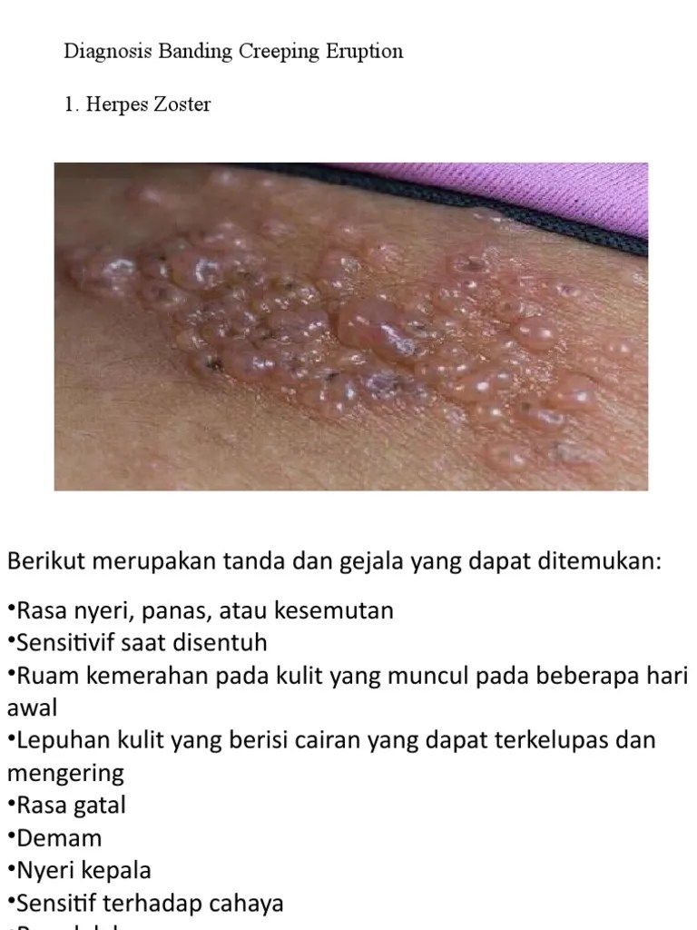 Diagnosis Banding Creeping Eruption PDF