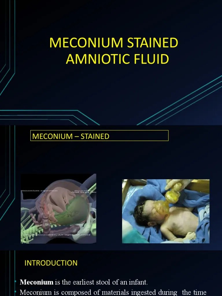 Meconium Stained Amniotic Fluid PDF Fetus Childbirth