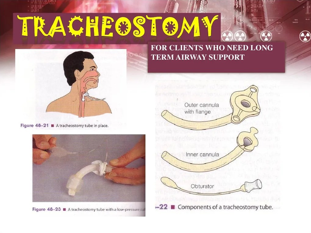 TRACHEOSTOMY Medicina clínica Especialidades médicas