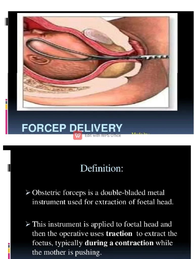 Forcep Delivery PDF