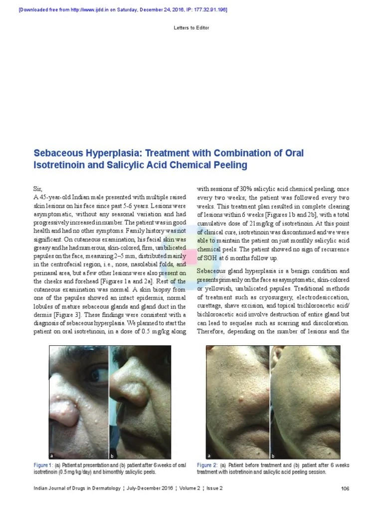 Sebaceous Hyperplasia Treatment With Combination o PDF Skin