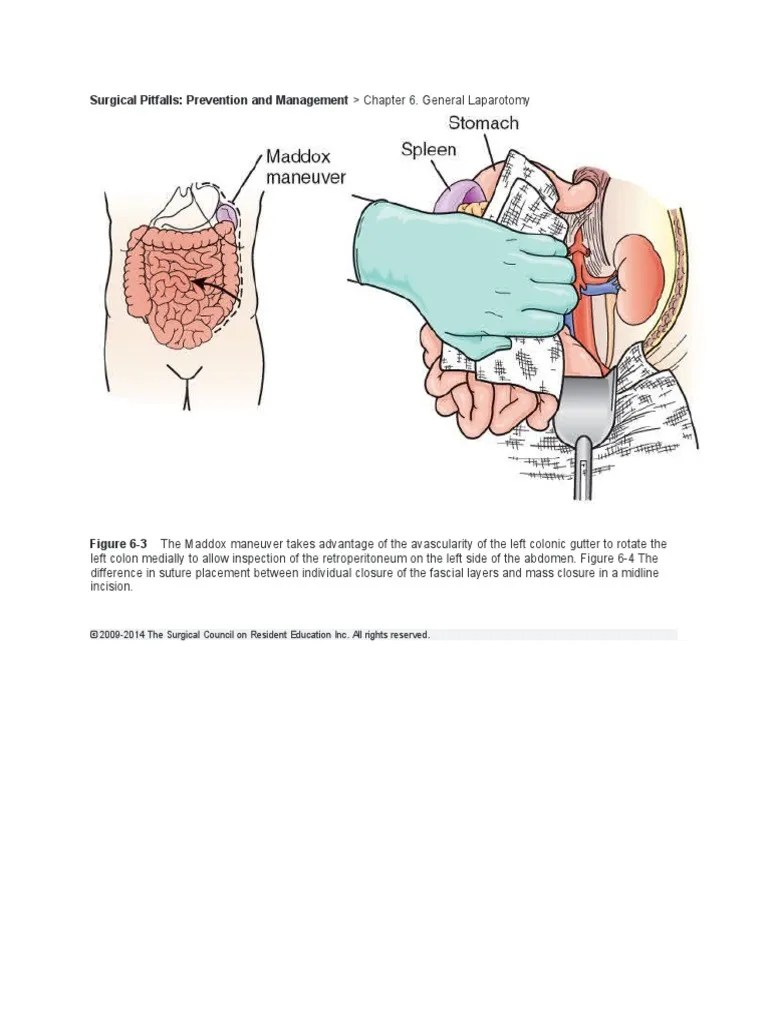 Mattox Maneuver PDF
