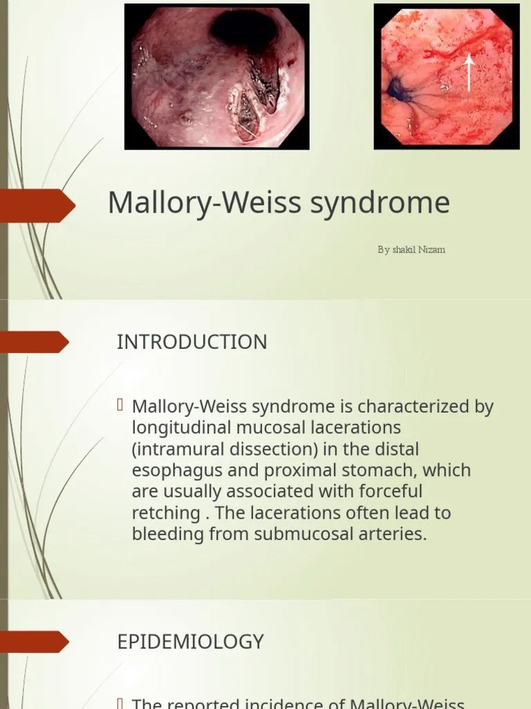 MalloryWeiss Syndrome PDF Esophagus Endoscopy