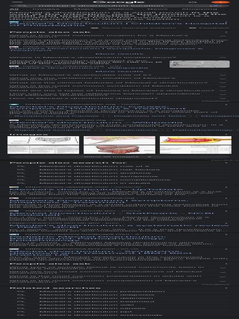 meckel's diverticulum PDF Medical Specialties Digestive Diseases