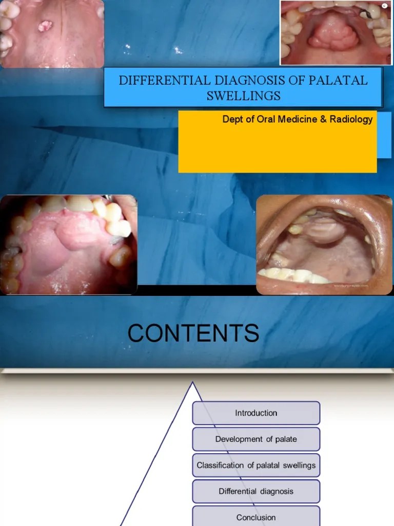 Differential Diagnosis of Palatal Swellings PDF