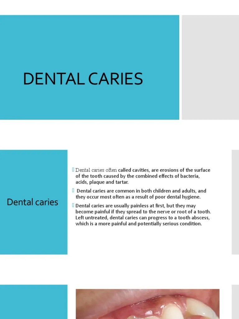 Dental Caries PDF Oral Hygiene Health Sciences