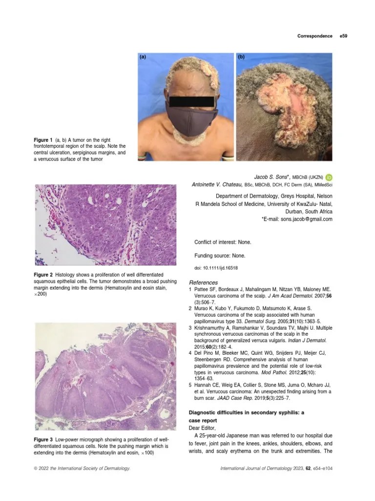 Int J Dermatology 2022 Iwasawa Diagnostic Difficulties in