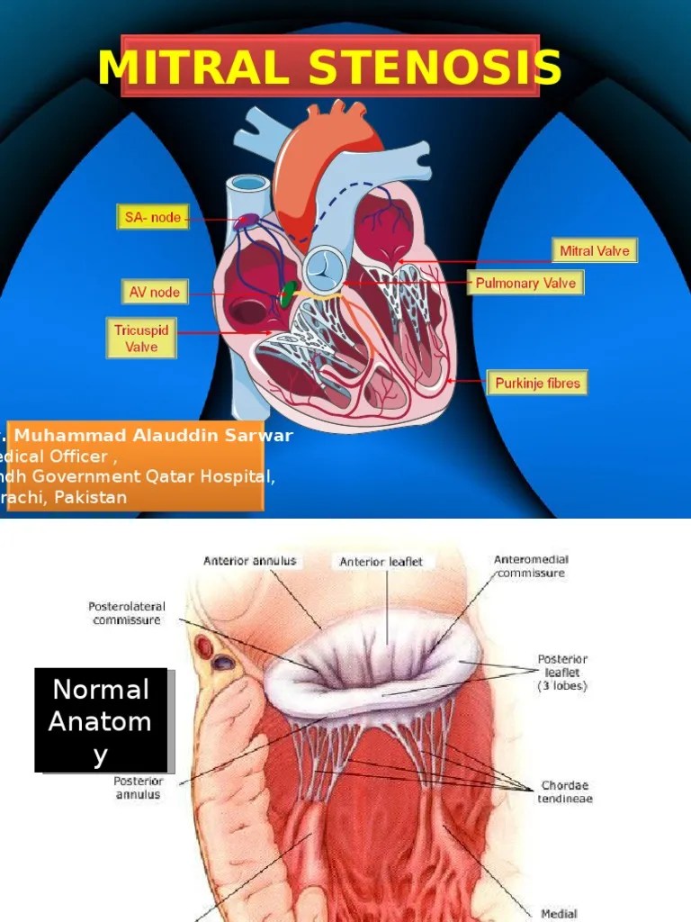 Mitral Stenosis Heart Valve Heart