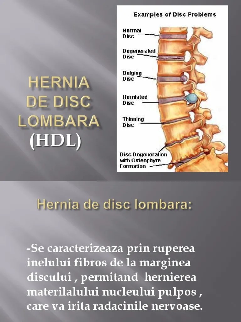 Hernia de Disc Lombara