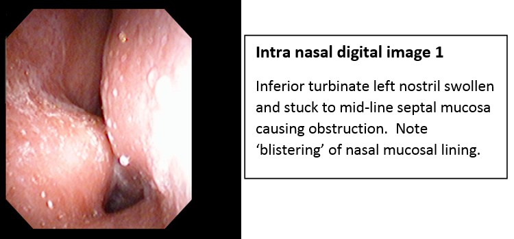 Severe Rhinitis Medicamentosa Successfully Treated With Rhinolight® Endonasal Uv Phototherapy – Irish Medical Journal