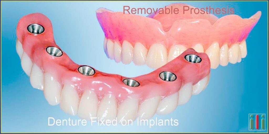 Immediate loading implantbased denture vs. Conventional denture