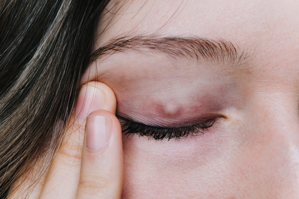 Chalazion, orgelet, on apprend la différence ? (Im)parfaites