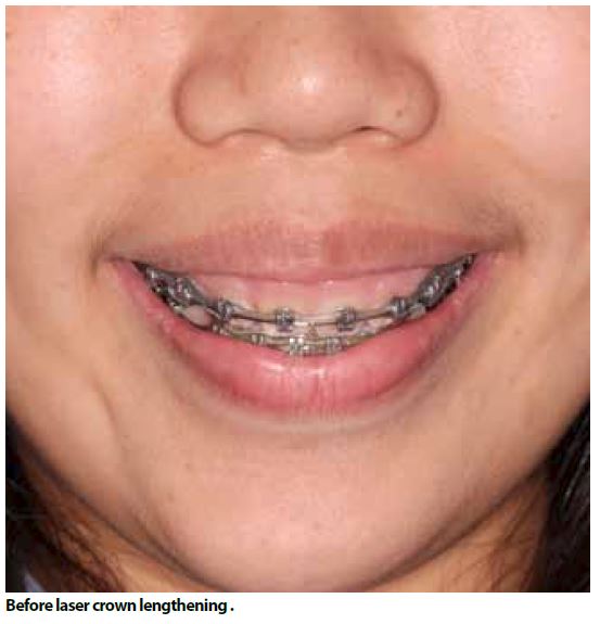 Laser Crown Lengthening with Dr. Kong Sheng Earn Imperial Dental