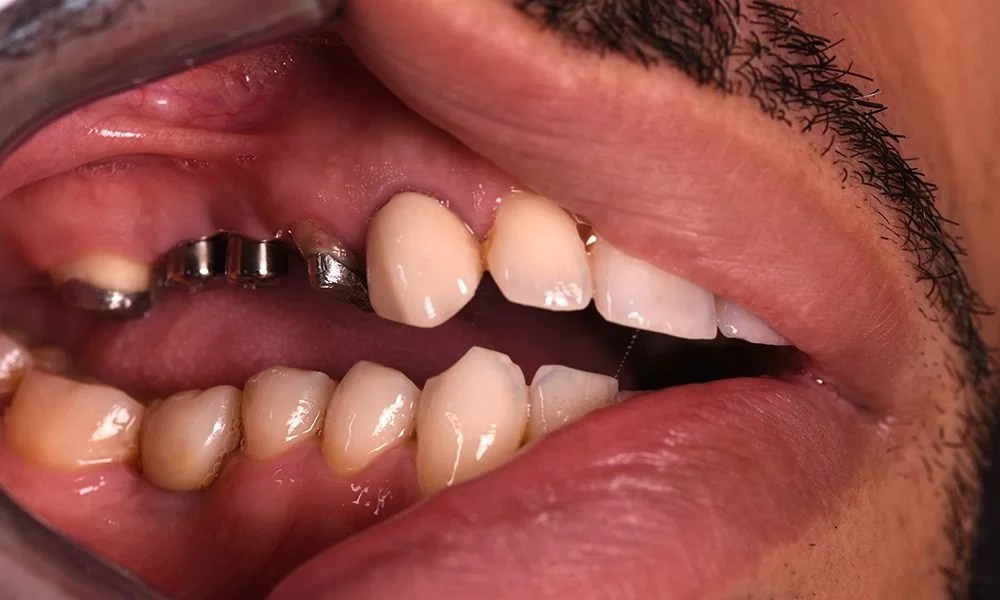 Dental Implant İmpladent