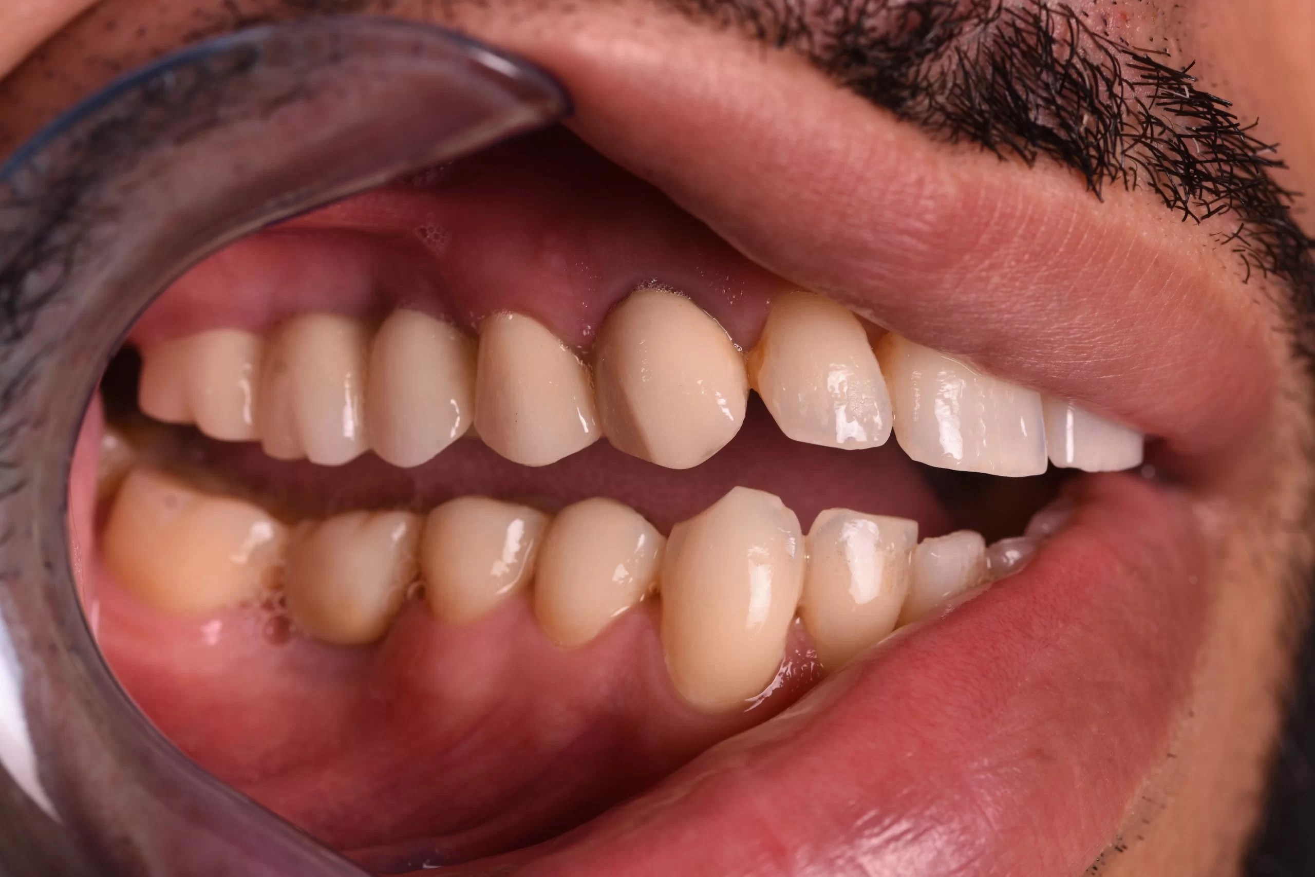 Dental Implant İmpladent