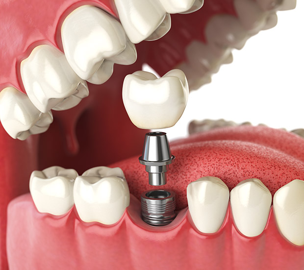 Will I Need a Bone Graft for Dental Implants? Impladent Implant