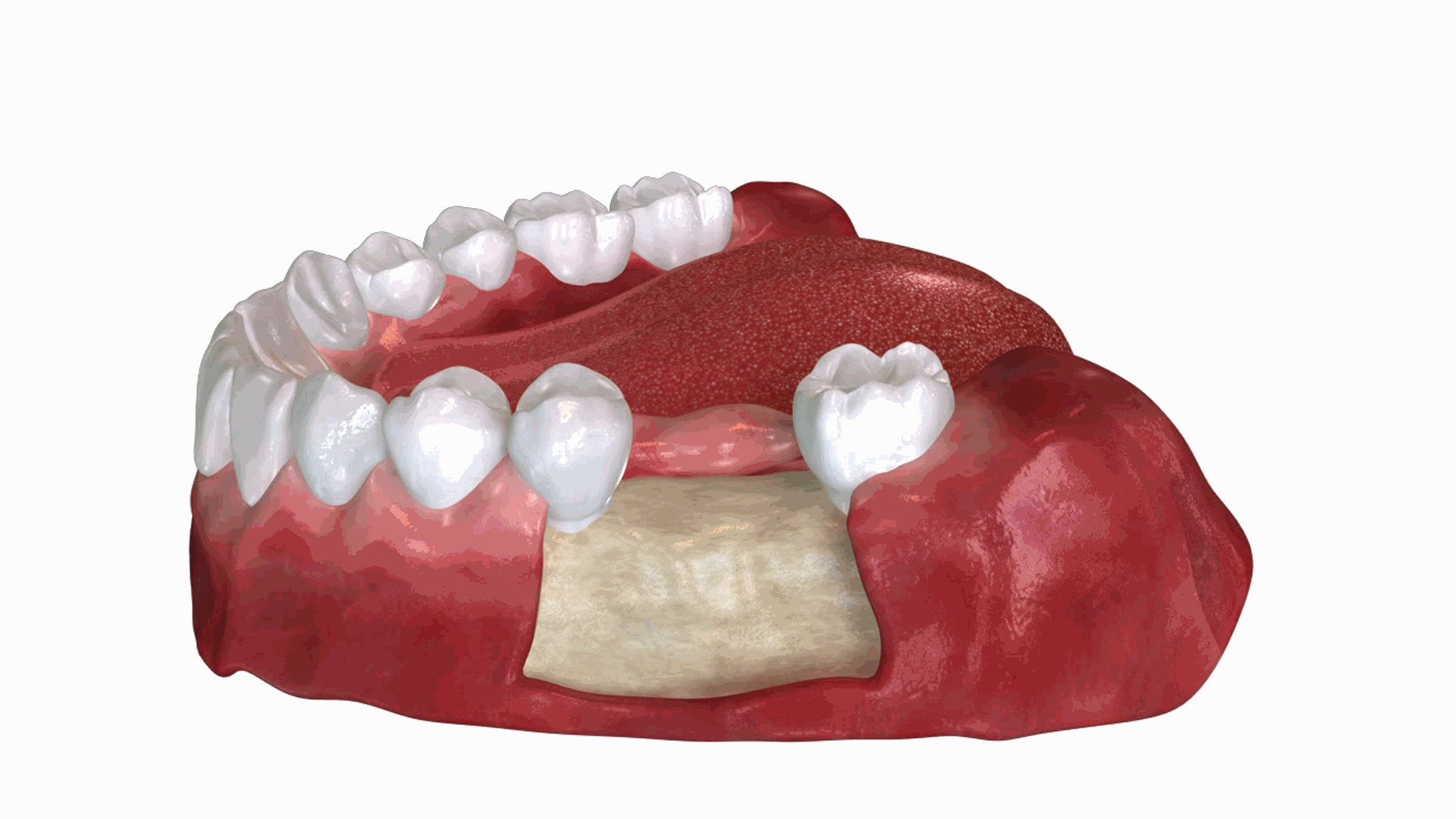 Changes After Tooth Loss Implantiem