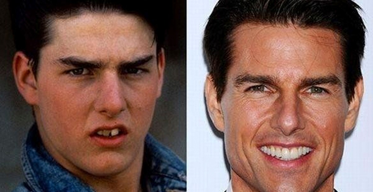 15 famosos que se hicieron un tratamiento de estética dental Clínica