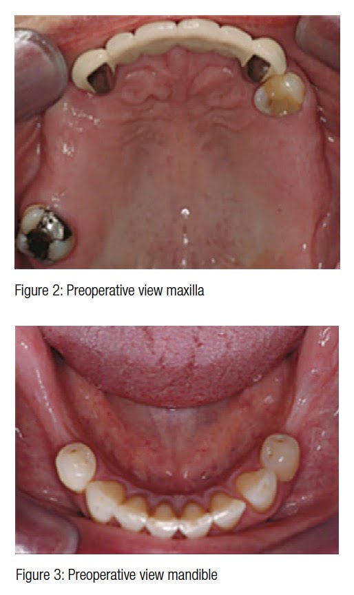 Implant CE Article Surgery in prevention of inferior alveolar nerve