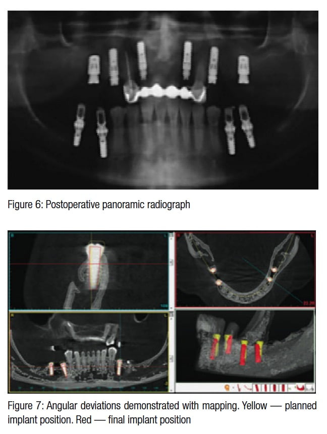 Implant CE Article Surgery in prevention of inferior alveolar nerve