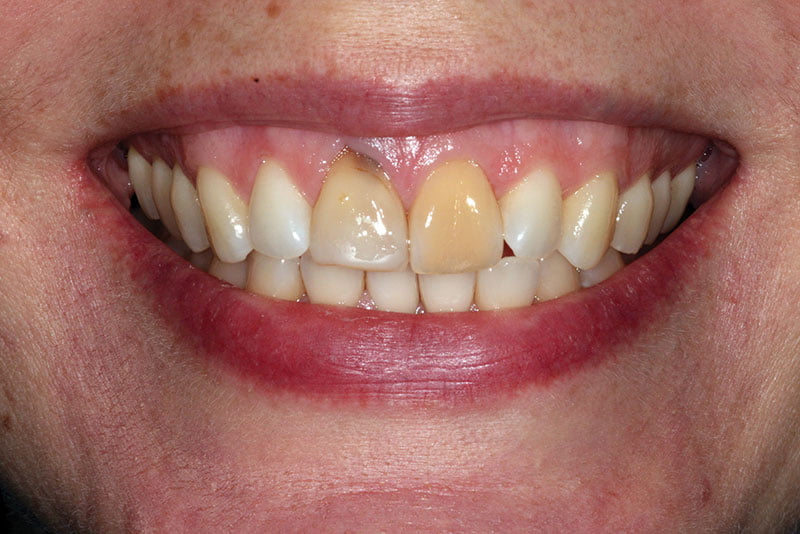 Single implant placement in the esthetic zone Implant Practice US