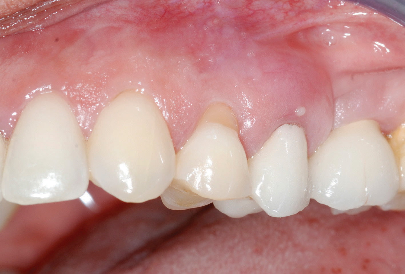 Implant CE Article Managing the failing dentition