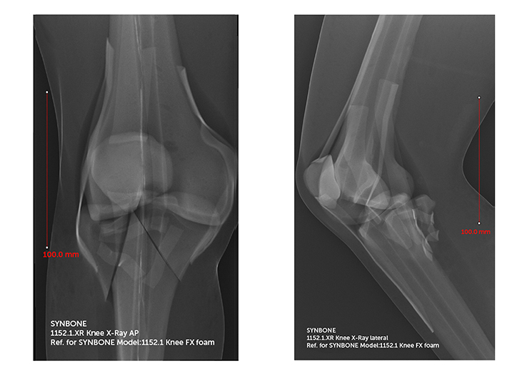 Knee right fractured w/ PCL a/ soft tissue Xray file SYNBONE