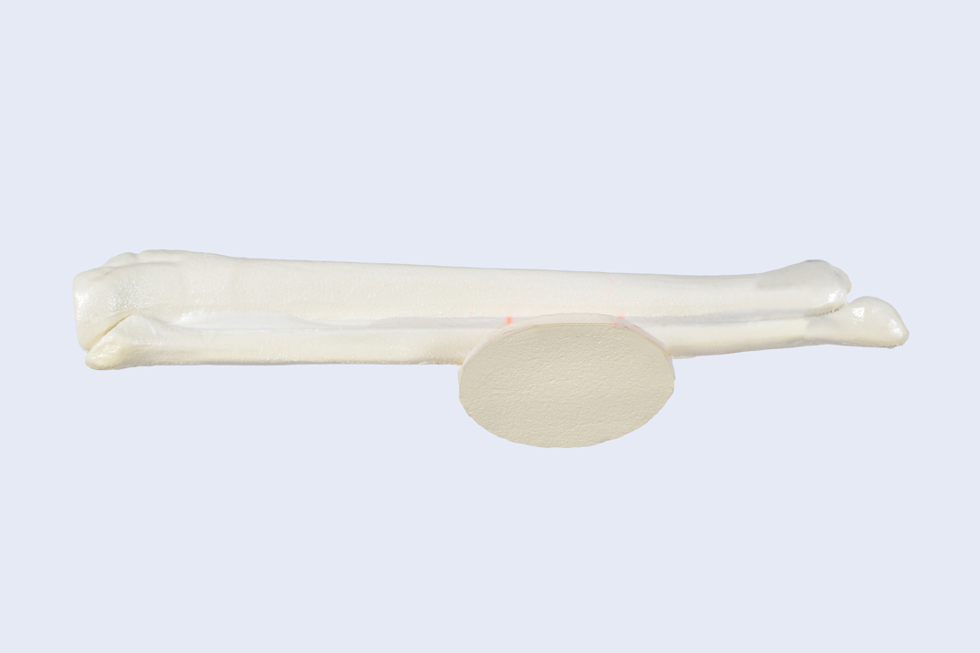 Tibia Fibula flap reconstruction - SYNBONE