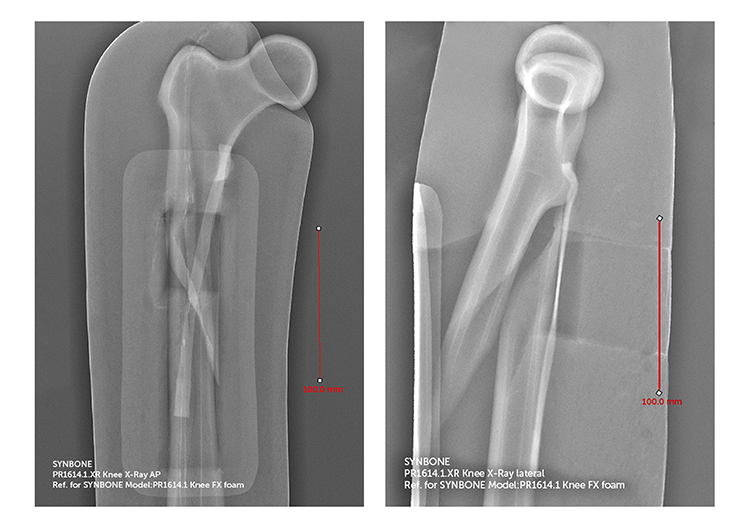 Knee right fractured w/ soft tissue Xray file SYNBONE