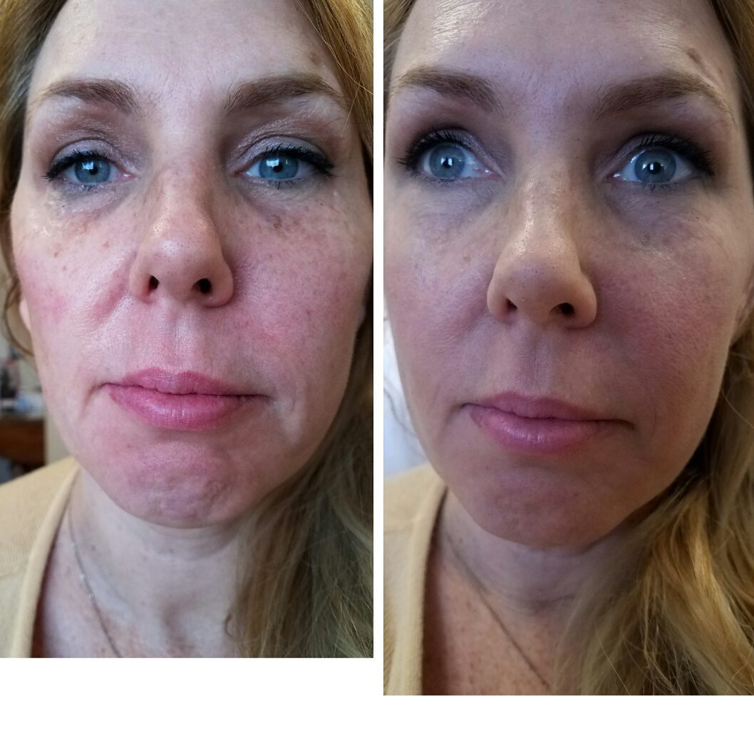 Dermal Fillers Positive Result Best Spa for Dermal Fillers