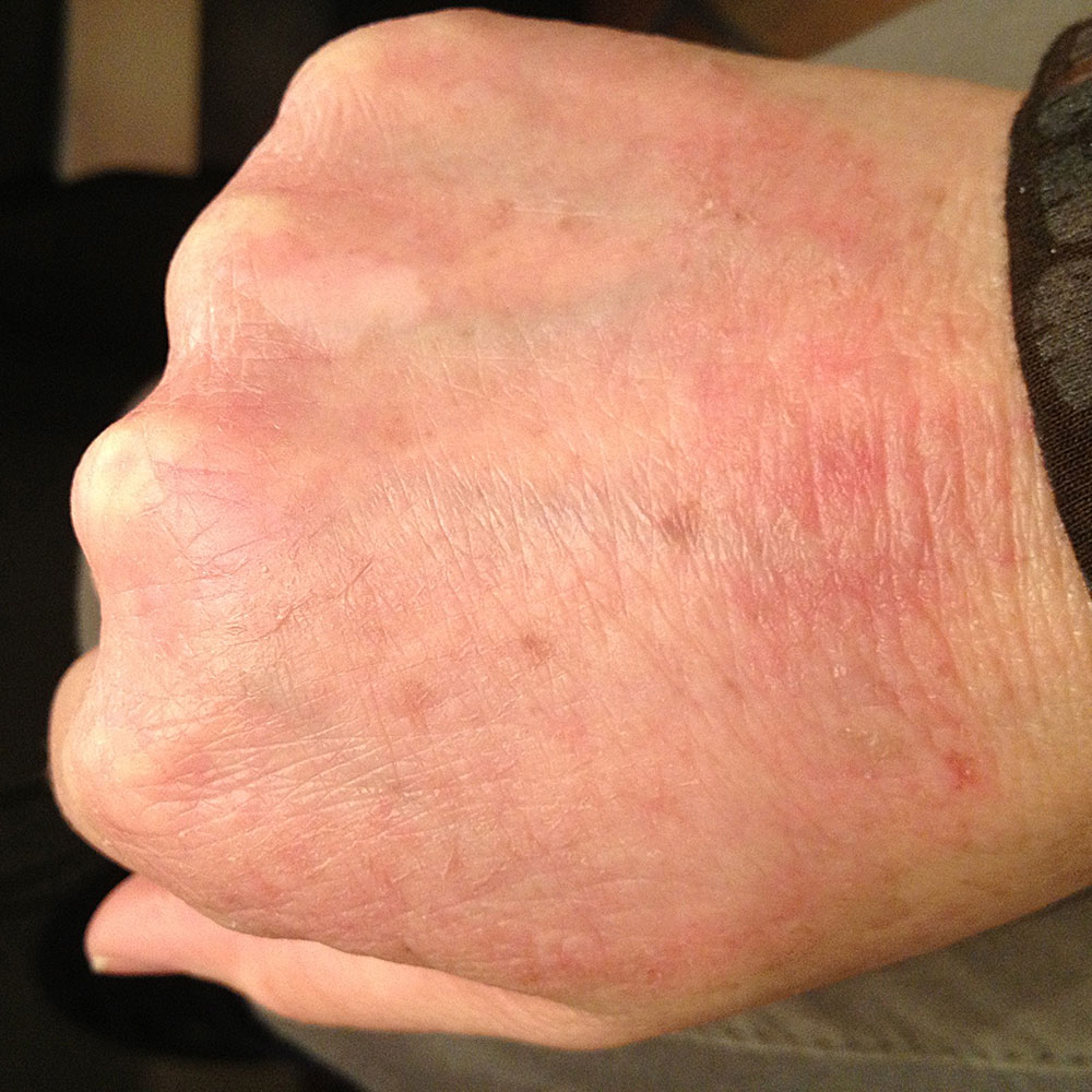 White Spots On Back Of Hands