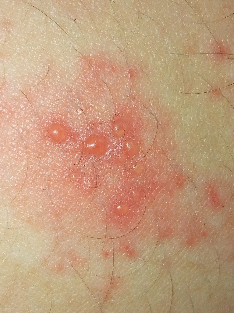 chicken pox in October 2020 by Nikita Gerasin. Herpes zoster · iNaturalist