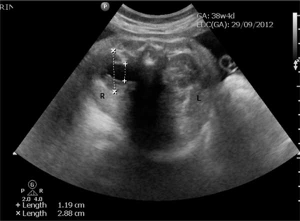 Revised Guidelines on Management of Antenatal Hydronephrosis