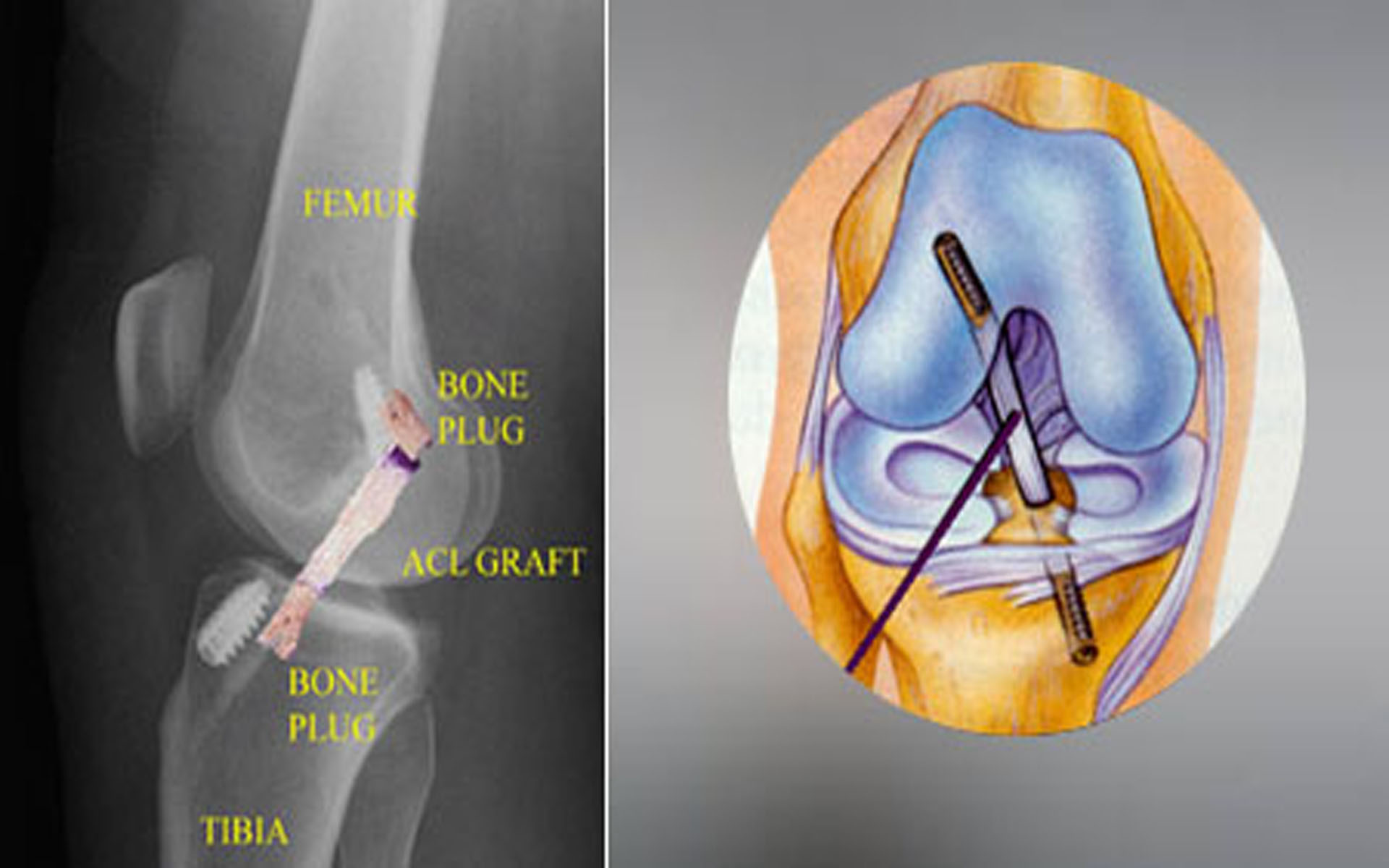 Knee Replacement Surgery in Hyderabad Best Knee Replacement Surgeon