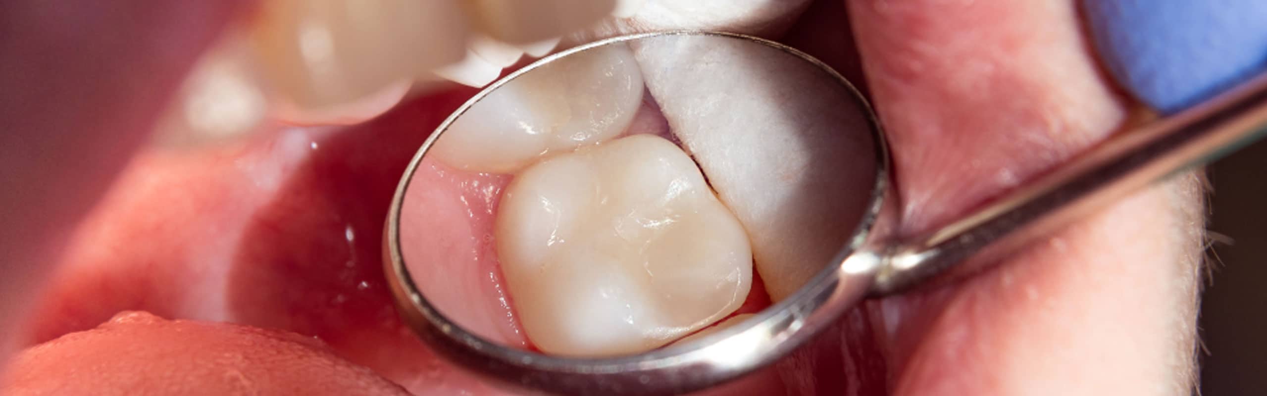 Empaste dental el método para tratar la caries Inensal