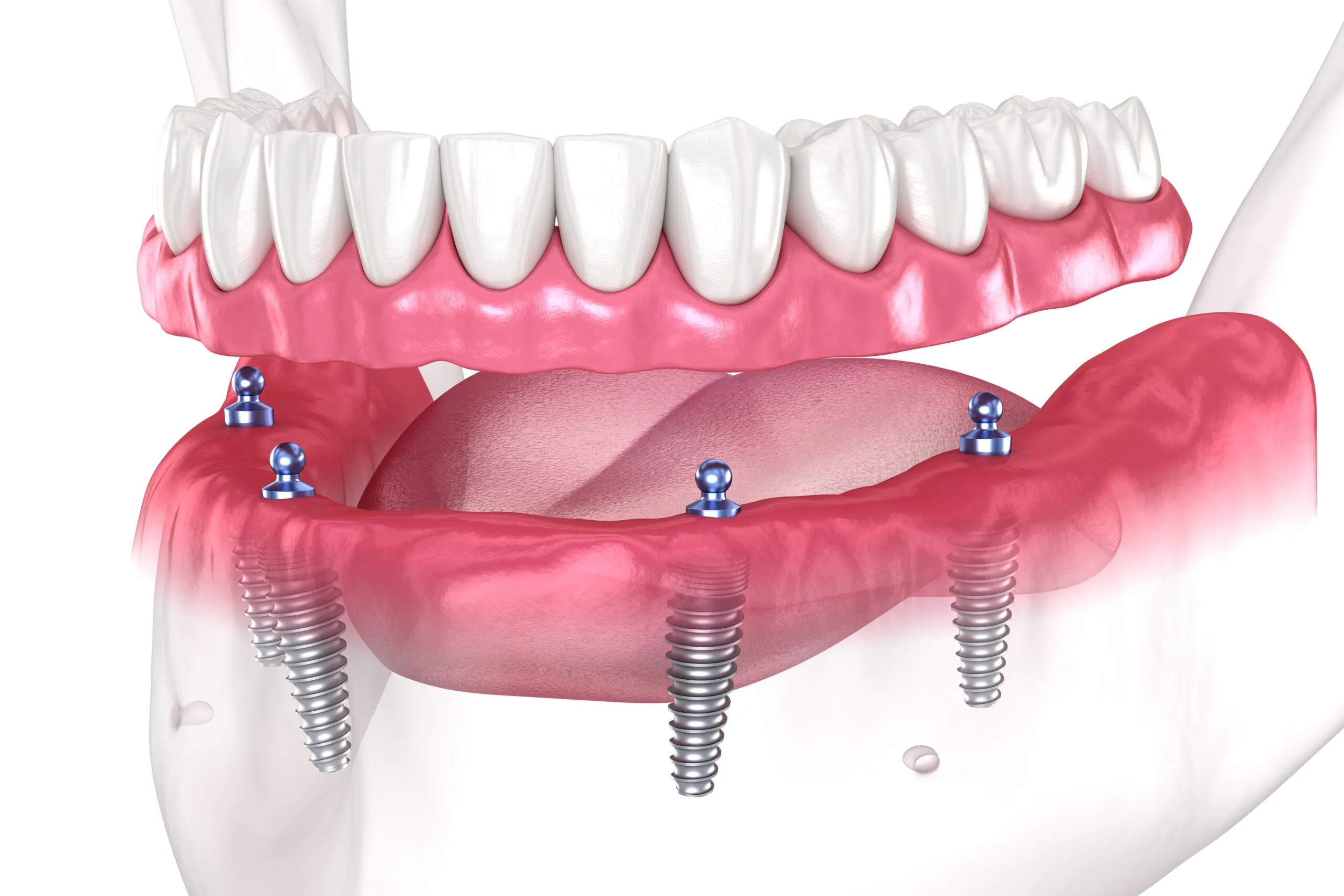 Affordable Dental Implants Near Me: Quick Options