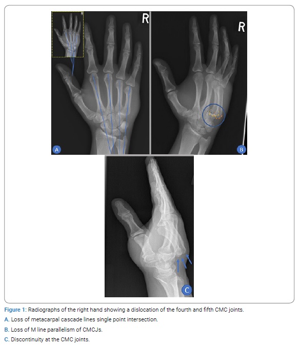 Delayed Closed Reduction and Cast Immobilization for Ring and Little