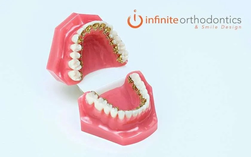 Incognito braces in Plano, Tx in Plano, TX Infinite Orthodontics