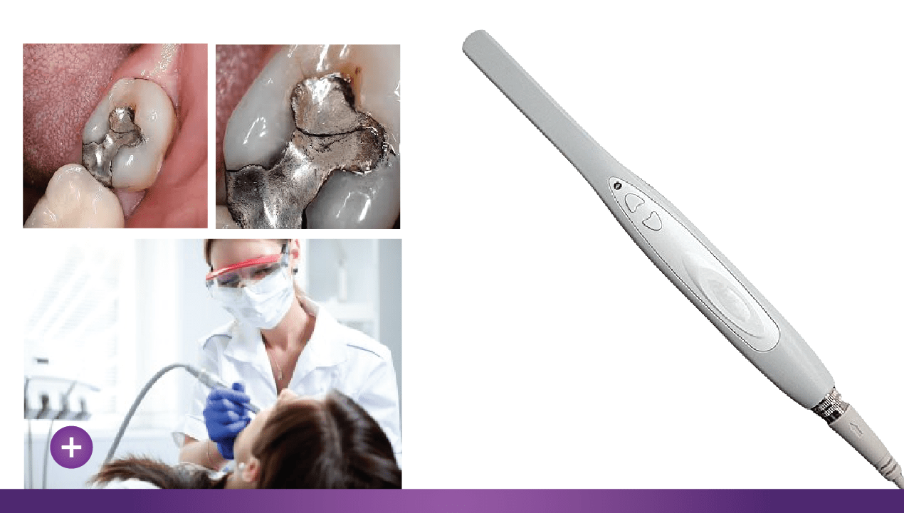 IntraOral Digital Camera Infinity Dental Associates