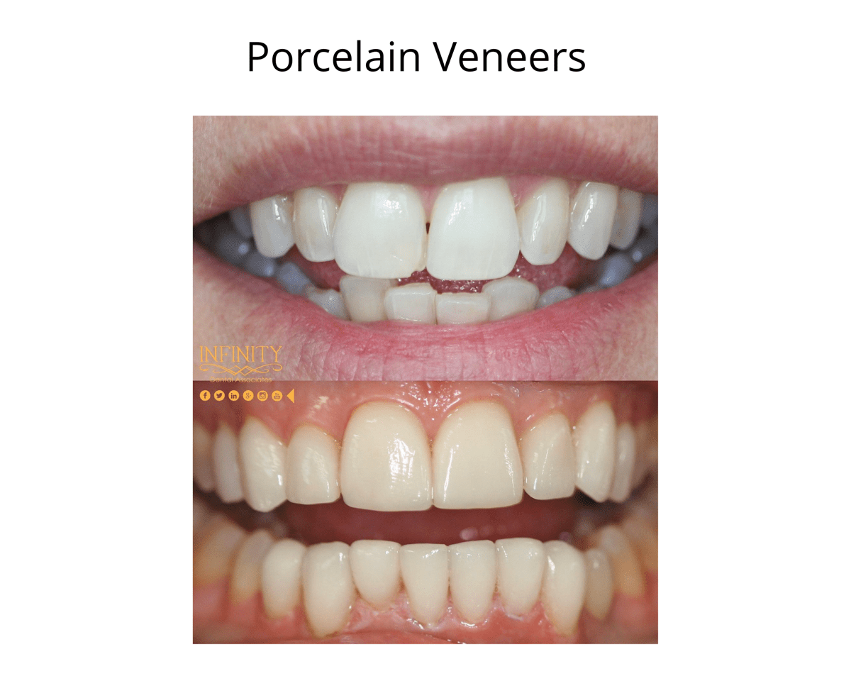 Veneers, Whitening, and Minimally Invasive Showcase Infinity Dental