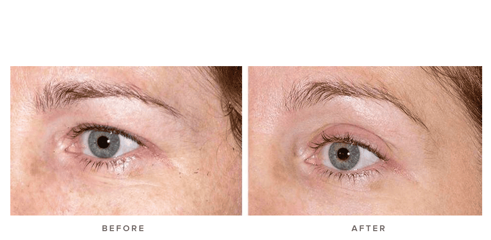 Thermage Eye Before and After Images Infinity Skin Clinic